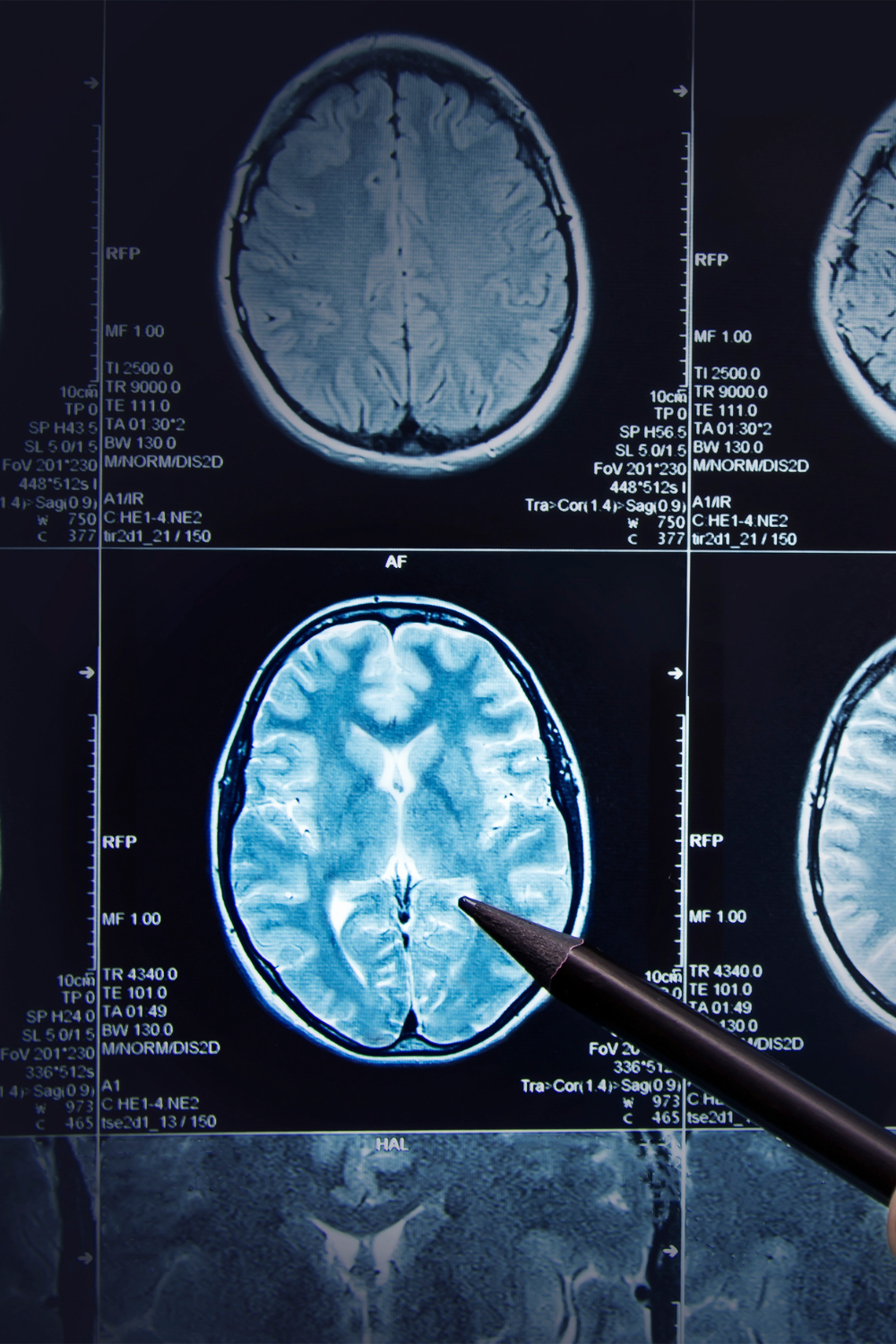 Enfermedades Cerebrovasculares