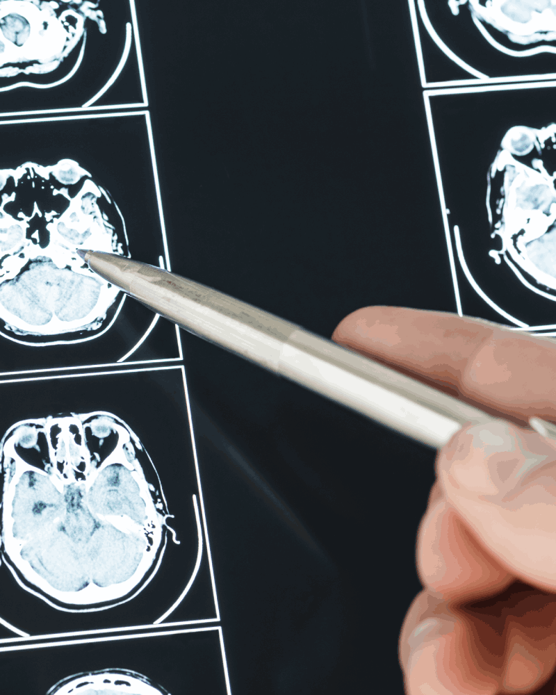 Costo De Cirugía de Tumor Cerebral