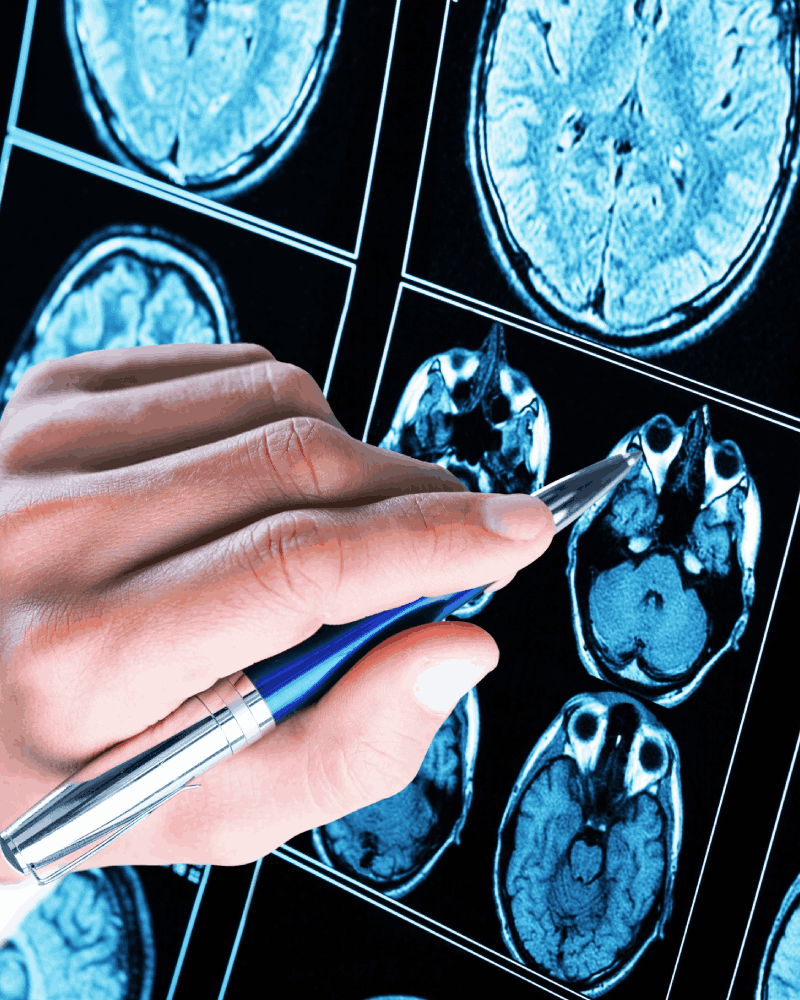 Mejor Neurocirujano para Tumores en CDMX