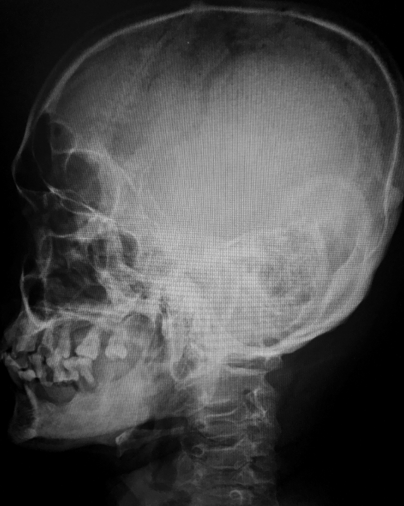 Neurocirugía Para Hidrocefalia Precio