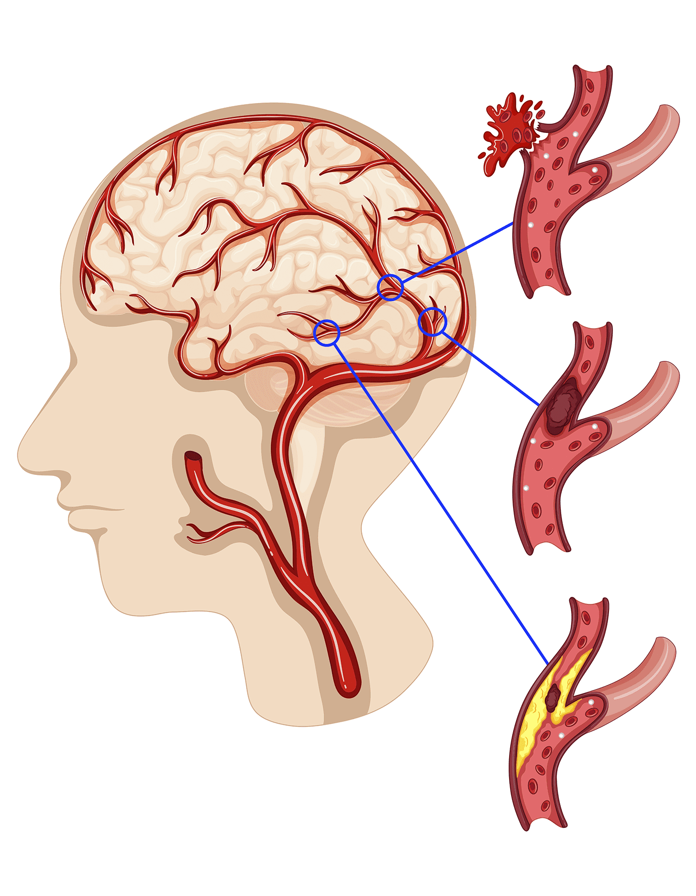 cirugias-de-aneurismas-cerebrales