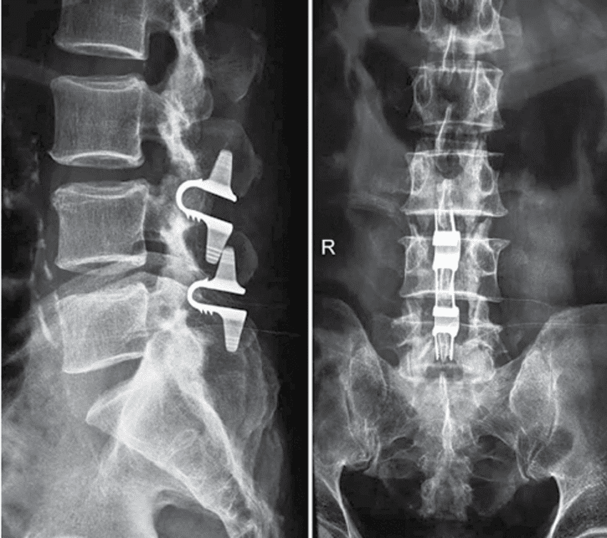 Espondilolistesis e Instrumentación