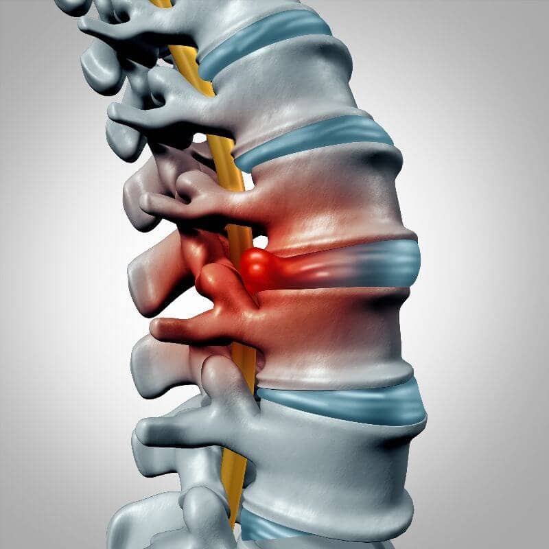 Hernia Discal