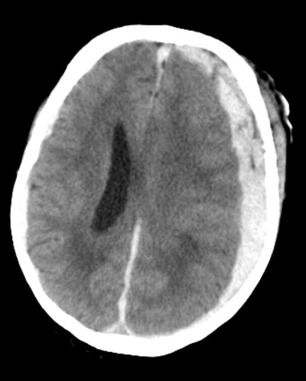 Trauma Craneal Hematoma Subdural